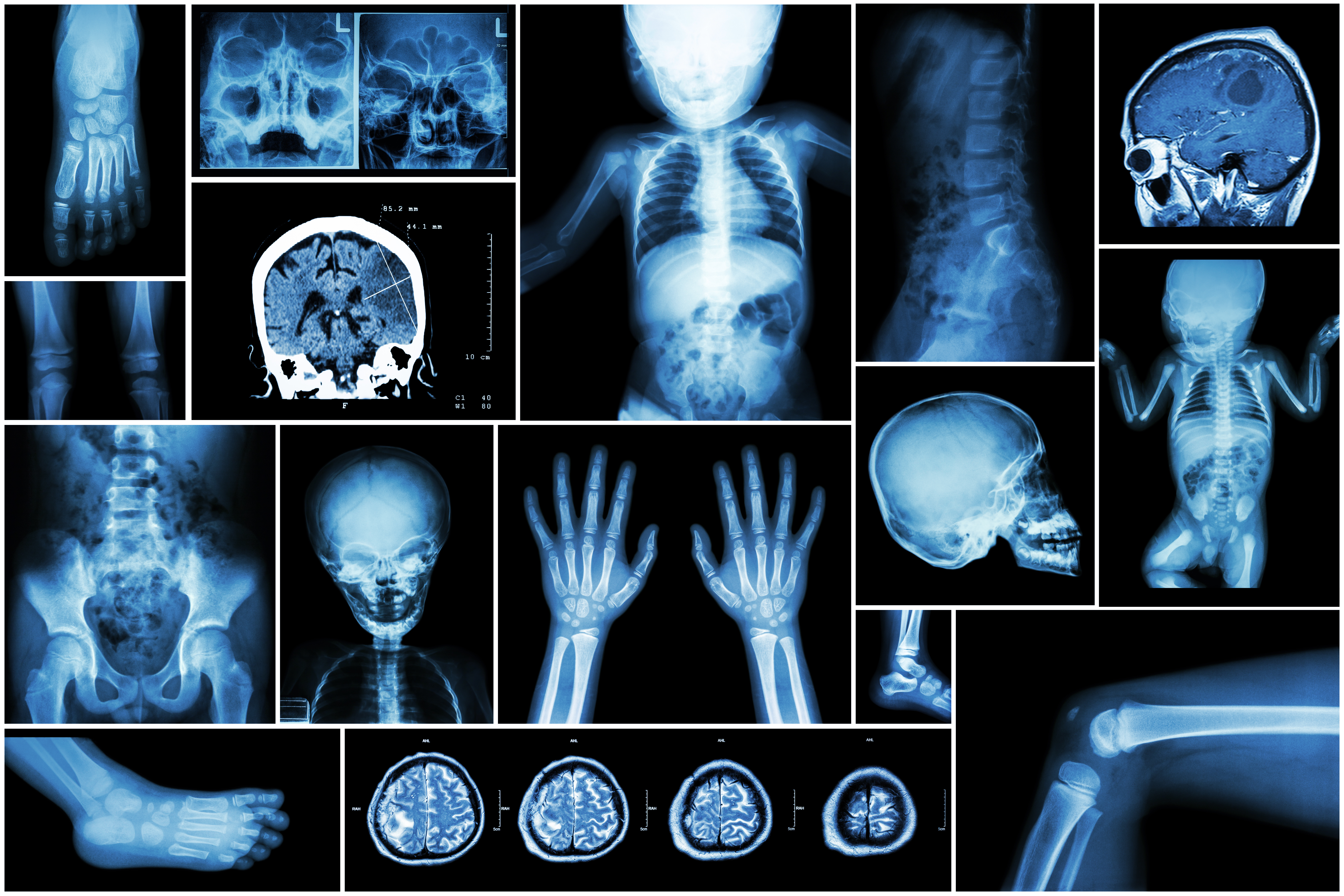 X-ray multiple part of child ‘s body & multiple disease ( stroke , brain tumor , rheumatoid arthritis , sinusitis , gouty arthritis , etc)( skull chest lung heart spine arm hand pelvis leg knee foot )