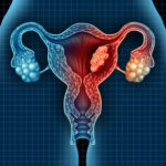 Endometrial and cervical cancer