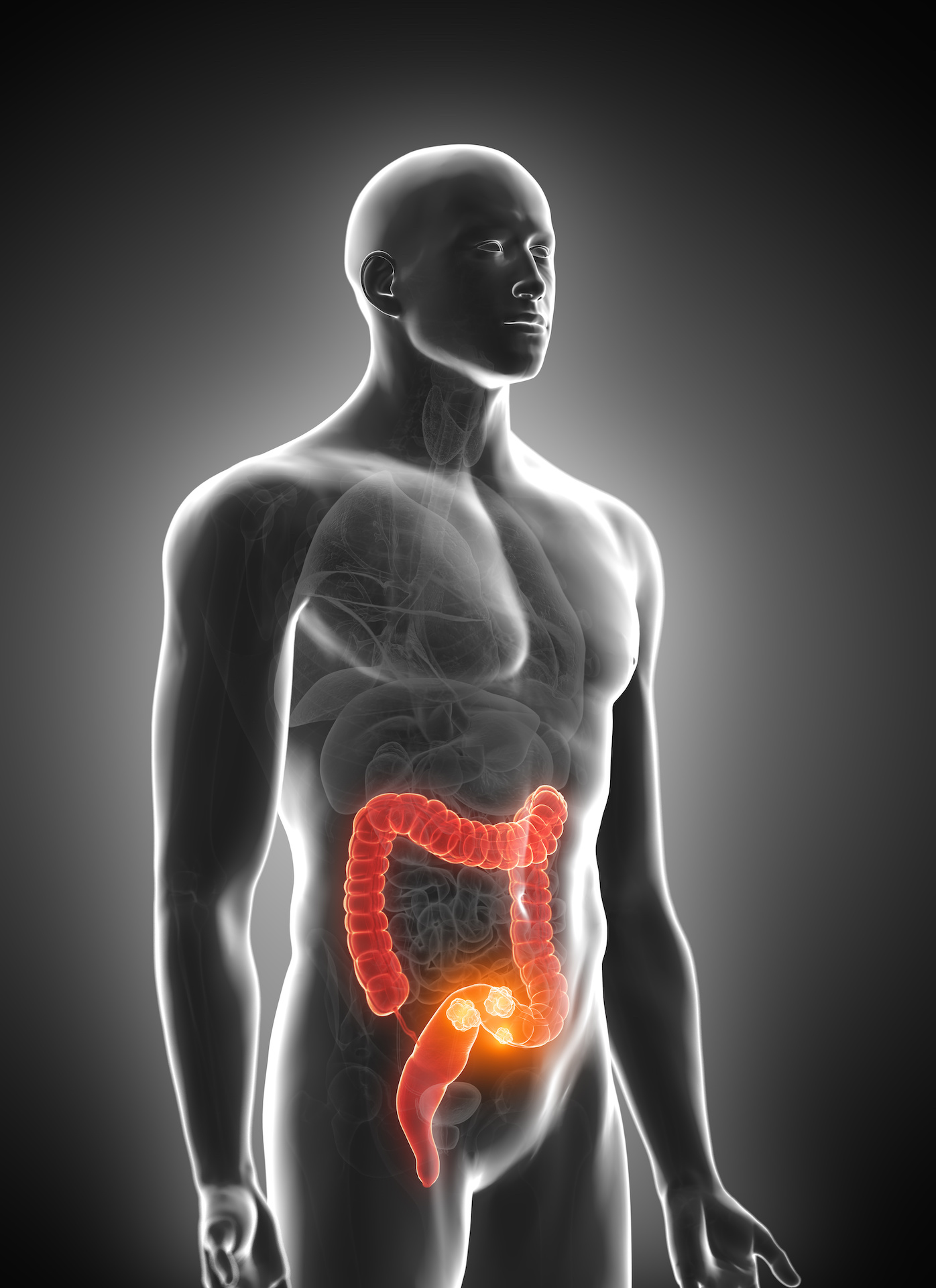 3d rendered medically accurate illustration of colorectal tumor
